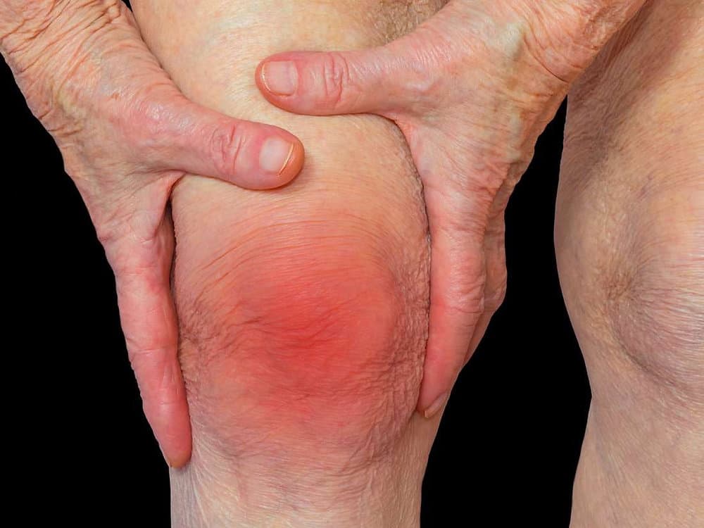 Rheumatoid Arthritis